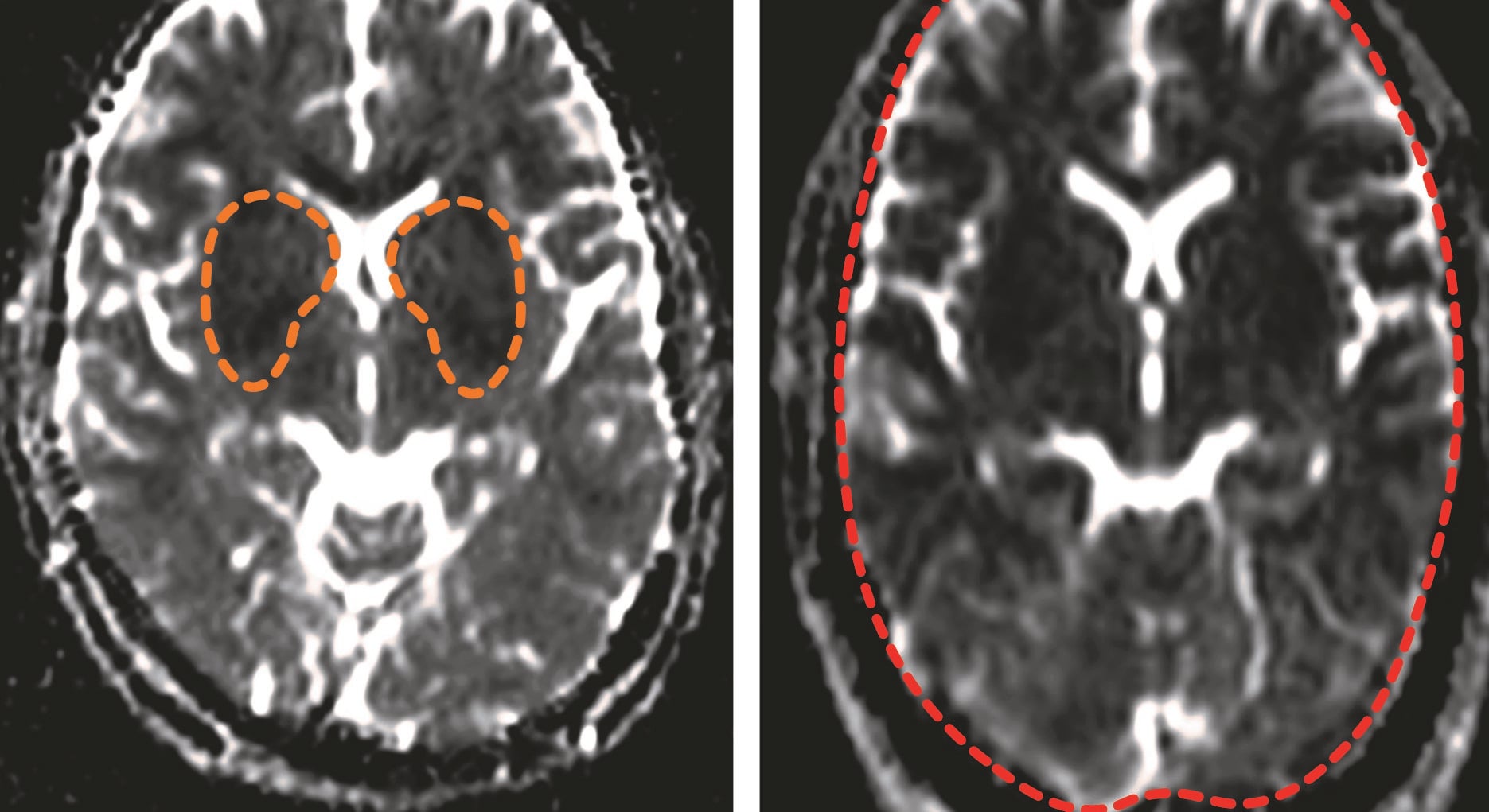 Malaria and the brain what longterm impact does malaria have on brain function? LSHTM